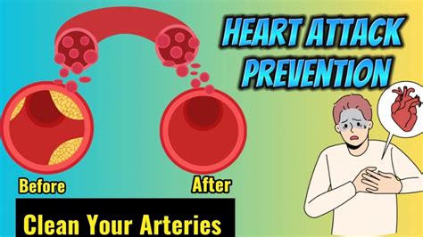 Top 5 Foods That Unclog Arteries Naturally And Prevent Heart Attack