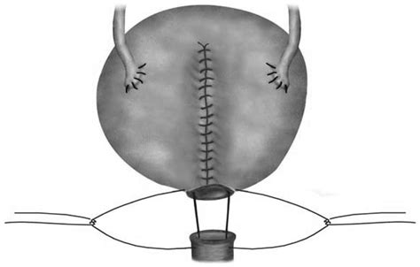 Early And Late Urodynamic Assessment Of The Orthotopic N‑shaped Neobladder