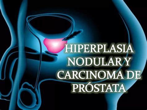 Hiperplasia Nodular Y Carcinoma De Pr Stata Ppt