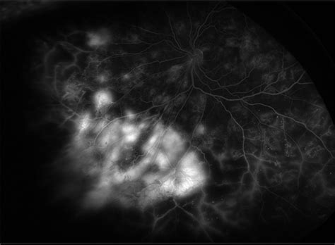 Proliferative Diabetic Retinopathy with Active Neovascularization ...