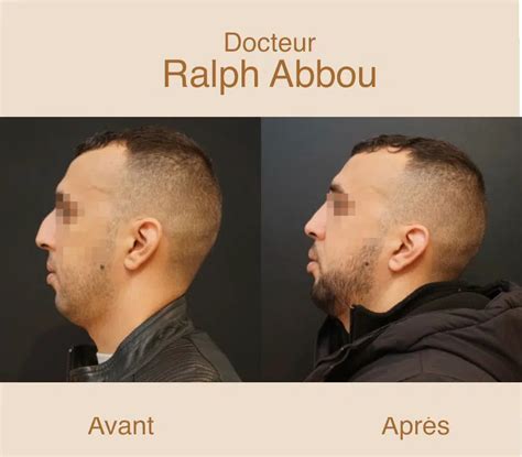 Reconstruction du nez à Paris Cancer du nez Dr Ralph ABBOU