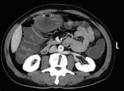 Axial Ct Image Shows A Retro Aortic Left Renal Vein Arrow