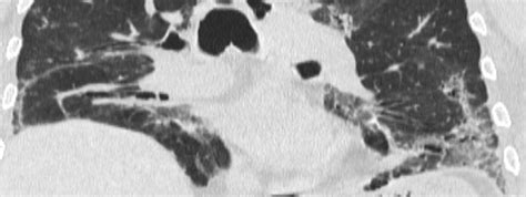 raiqc packages package interstitial lung disease  hrct