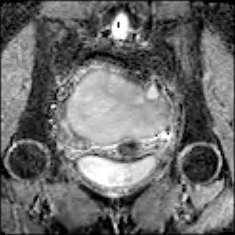 Ovarian Torsion Symptoms