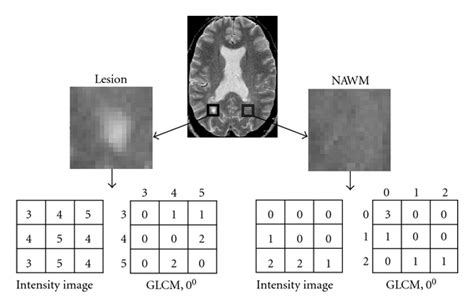 Schematic Demonstration Of Texture Analysis In The T2 Weighted Mr Image