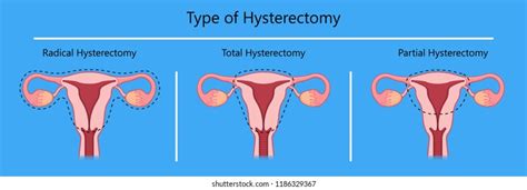 Hysterectomy Procedure Indications Complications 55 Off