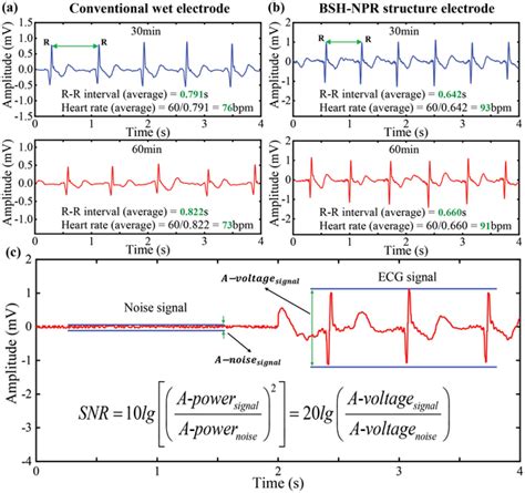 ECG long‐term monitoring of different electrodes on the volunteer's ...