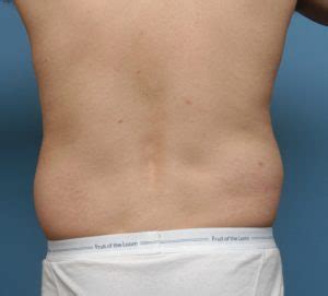 Male Flank Liposuction Back Before Dr Barry Eppley Indianapolis