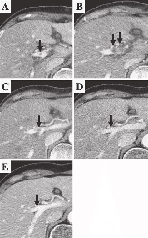 Figure Follow Up Computed Tomography A One Month Postoperatively