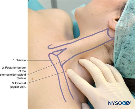 Bloc Interscal Nique Du Plexus Brachial Technique Des Rep Res Et