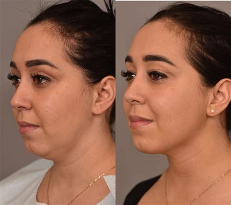 Neck Chin Liposuction New York City