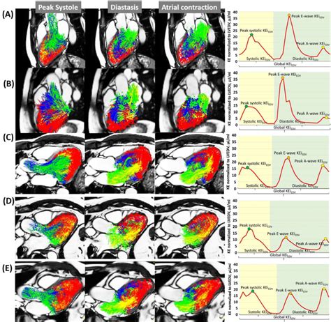 Impact Of Age Sex And Ethnicity On Intra Cardiac Flow Components And