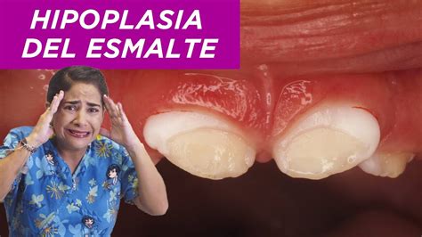 Hipoplasia Del Esmalte Youtube