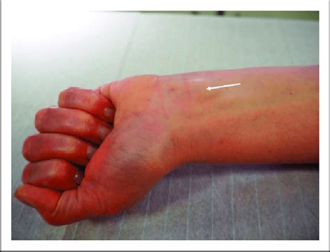 Initial Presentation Showing A Visible Lump On The Volarulnar Aspect