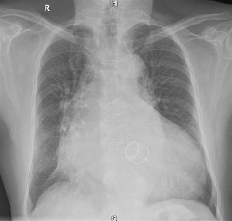 What Type Of Prosthetic Valve Is Seen On This Chest X Ray All About