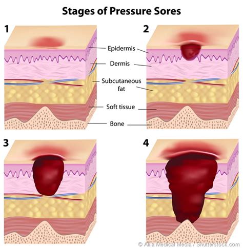 Innovative mattresses to stop pressure ulcers: an interview with Mike ...