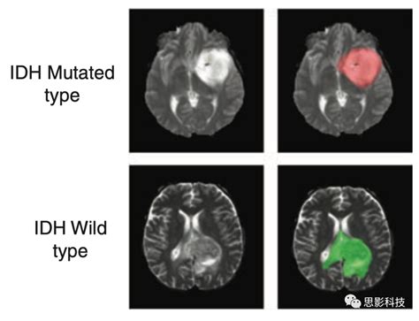 Neuro Oncology：对脑胶质瘤idh突变状态进行分类的一种基于mri的全自动深度学习算法 知乎