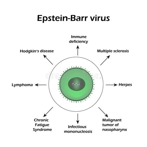 Epstein Barr Virus Diseases Caused By A Virus Infographics Stock Vector Illustration Of