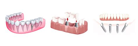 Different Types Of Dental Implants Dental Clinic