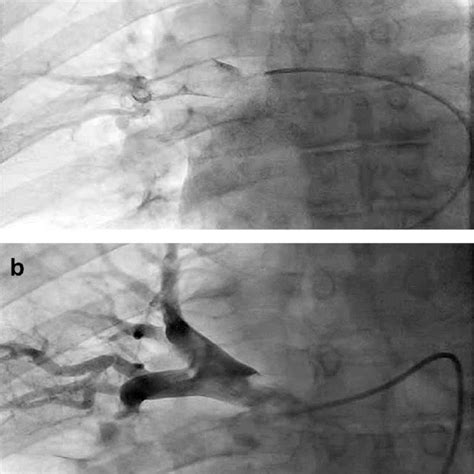 E A Pulmonary Angiogram Demonstrating The Right Main Pulmonary Artery Download Scientific