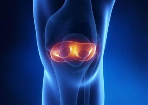 Meniscal Root Tear Torn Meniscus Root Orthopedic Knee Specialist Manhattan Brooklyn New