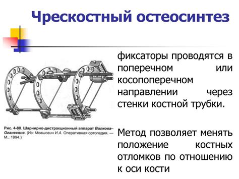 Операции на костях. Остеотомия и остеосинтез. Реплантация конечностей ...