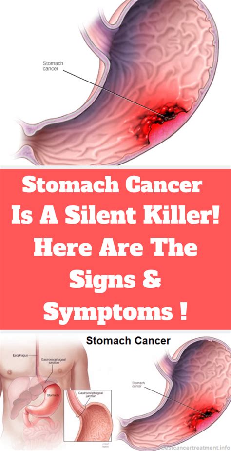 Signs You Have A Stomach Bug