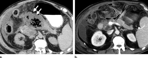 Subacute Pancreatitis With Infected Necrosis A Preoperative Axial Download Scientific