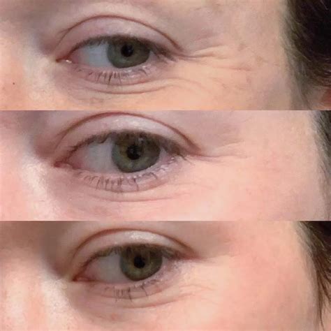 Microneedling Under Eyes Effects Pain Cost And More