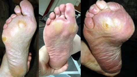 Foot Plantar Keratosis