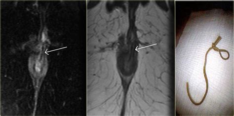 The Radiology Assistant : Perianal Fistulas