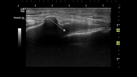 Ultrasound Guided Caudal Epidural Steroid Injection Sonosite Ultrasound