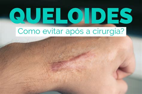 Queloides como evitá las após uma cirurgia Guia Saúde Cidades