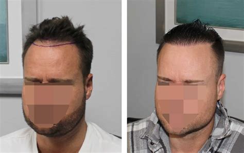 Hairline Surgery Safety First Hair Transplant - Riset