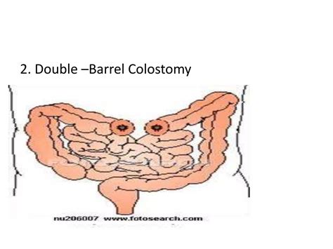 Colostomy | PPT