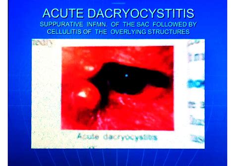 SOLUTION Diseases Of Lacrimal System 2 Studypool