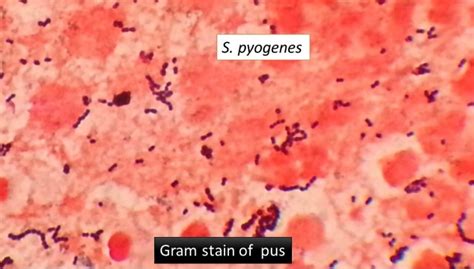 Pus Having Streptococcus Pyogenes Introduction And Its Gram Stain