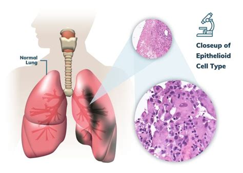 Pleural Mesothelioma Treatment Prognosis And Survival