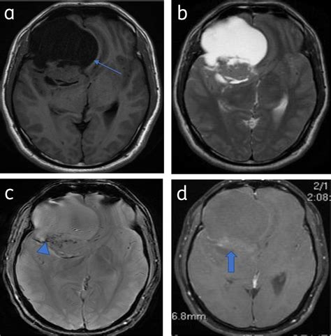 Myriad Presentations Of Intracranial Meningiomas Pictoral Essay