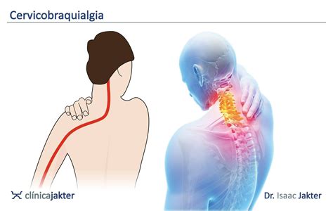 Qu Es La Cervicalgia Causas Sntomas Y Tratamiento