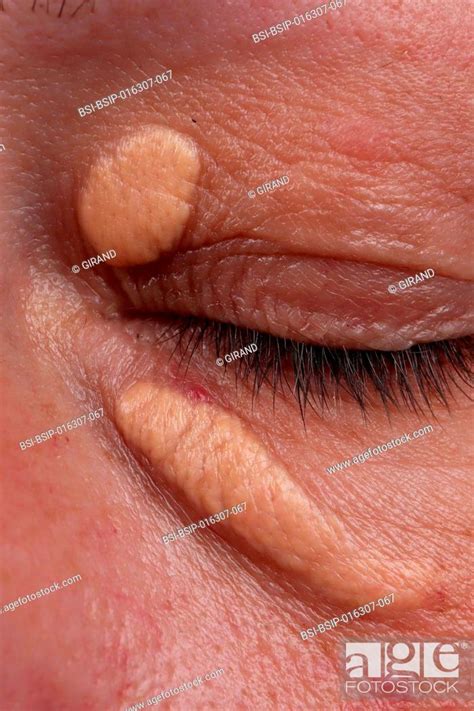 Xanthelasma Of The Eyelids In A Year Old Woman Stock Photo Picture