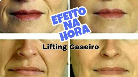 Lifting Caseiro Efeito Na Hora Bigode Chinês Rugas E Linhas De Expressão Youtube