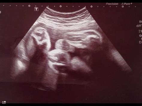 30 Weeks Pregnant Ultrasound Boy