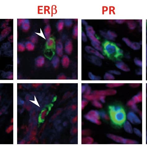 Summary Immunoexpression Of Steroid Receptors In Human Uterine Mast