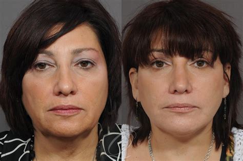 Chin Augmentation Before After Photos Patient 55 Serving Rochester