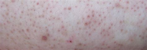 Eczema Vs Keratosis Pilaris Do You Know The Difference The Eczema Company Blog Blog