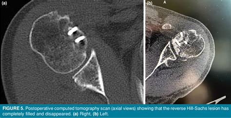 Figure 5 From Bilateral Locked Posterior Shoulder Dislocation