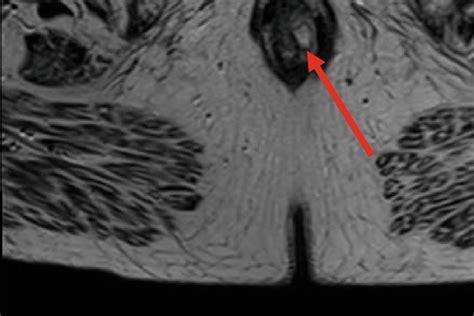 T2 Weighted Axial Magnetic Resonance Imaging Of The Patient