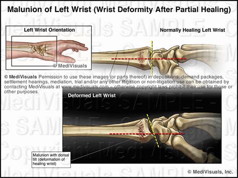 The Medical Legal Exhibit Expert Blog Complications Associated With Fracture Injuries