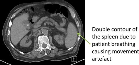 Ct Artefacts Radiology Cafe